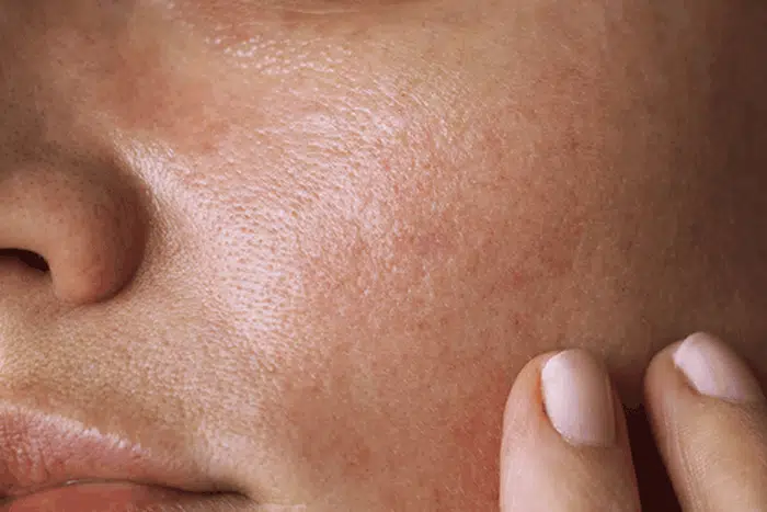 Comment prendre soin de la peau mixte ?