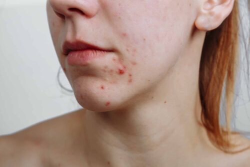 Quels sont les traitements disponibles et efficaces contre l’acné à Genève ?